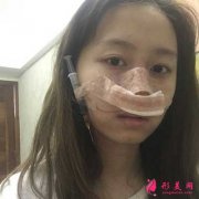 西安西京醫(yī)院美容科隆鼻案例分享