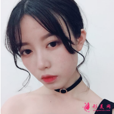 生命加醫(yī)療美容醫(yī)院做鼻子怎么樣？假體隆鼻術(shù)后90天效果真的好