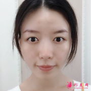 西安西京醫(yī)院美容科哪位醫(yī)生做鼻子比較好？隆鼻案例