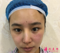 西安西京醫(yī)院美容科雙眼皮手術(shù)案列分享