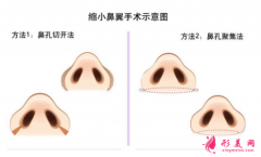 做鼻翼縮小手術(shù)安全嗎？