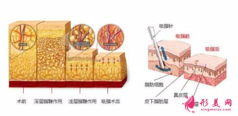 　吸脂手術(shù)簡(jiǎn)介