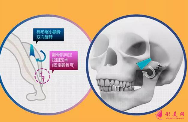 手術(shù)后的效果理想嗎?