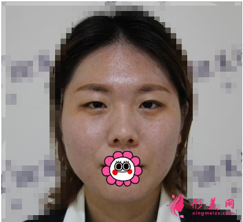 成都米蘭柏羽吳江山做雙眼皮怎么樣？48天前后對比圖案例分享