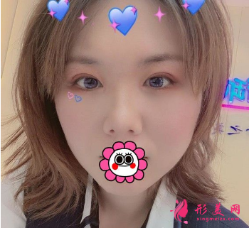 成都米蘭柏羽吳江山做雙眼皮怎么樣？48天前后對比圖案例分享