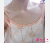 廣州海峽整形醫(yī)院怎么樣？周旭剛隆胸做的好嗎？周旭剛隆胸案例分