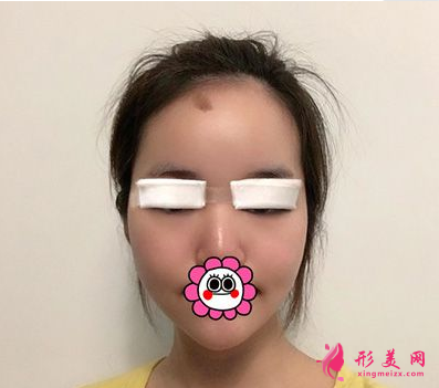 杭州藝星整形樸正馨做雙眼皮手術(shù)怎么樣？60天前后對比圖案例分享
