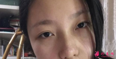 杭州格萊美熊滔做隆鼻好不好？熊滔隆鼻案列分享