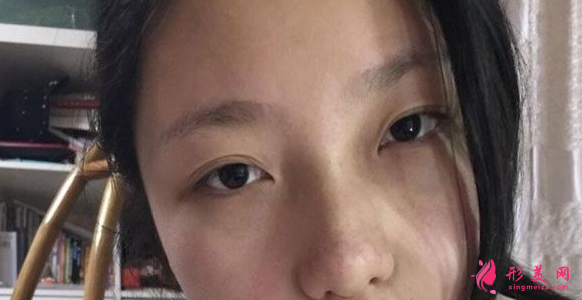 杭州格萊美熊滔醫(yī)師真人隆鼻案例 90天前后對比蛻變分享