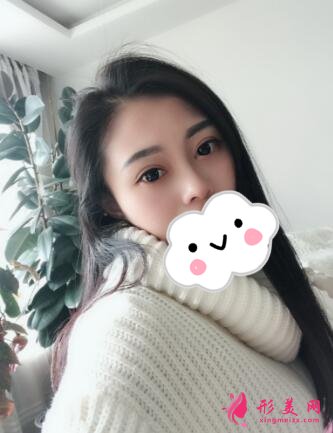 深圳羅金剛雙眼皮案例，術(shù)后變化就是這么大！