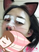 深圳羅金剛雙眼皮怎么樣？，雙眼皮術(shù)后分享，變化就是這么大！