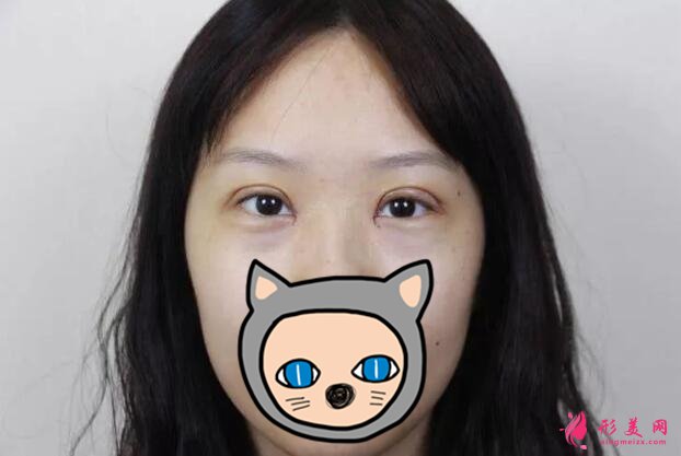 深圳葉琳雙眼皮案例，把小姐姐的美分享給大家