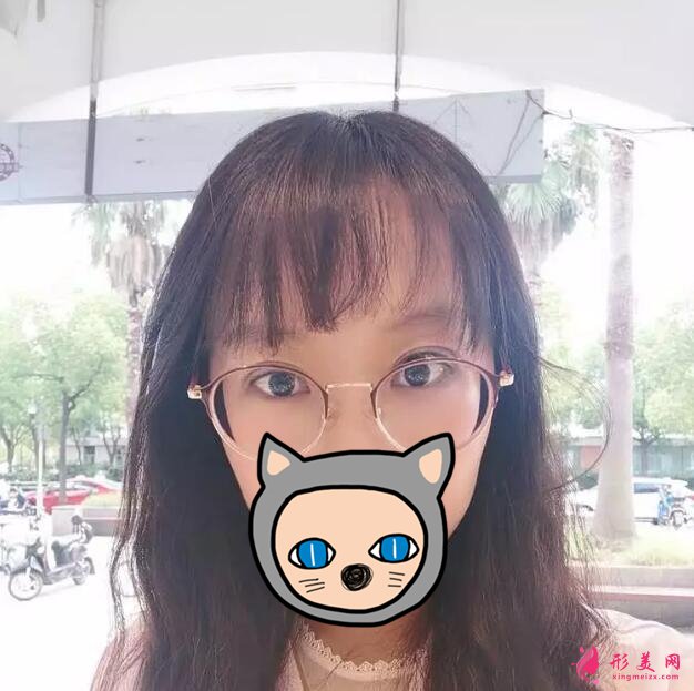 深圳葉琳雙眼皮案例，把小姐姐的美分享給大家