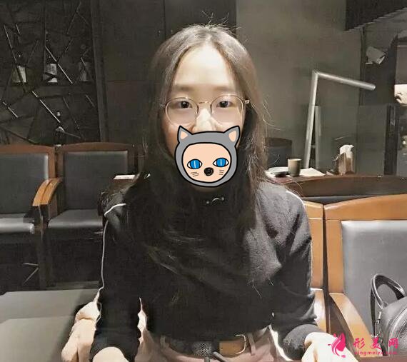 深圳葉琳雙眼皮案例，把小姐姐的美分享給大家