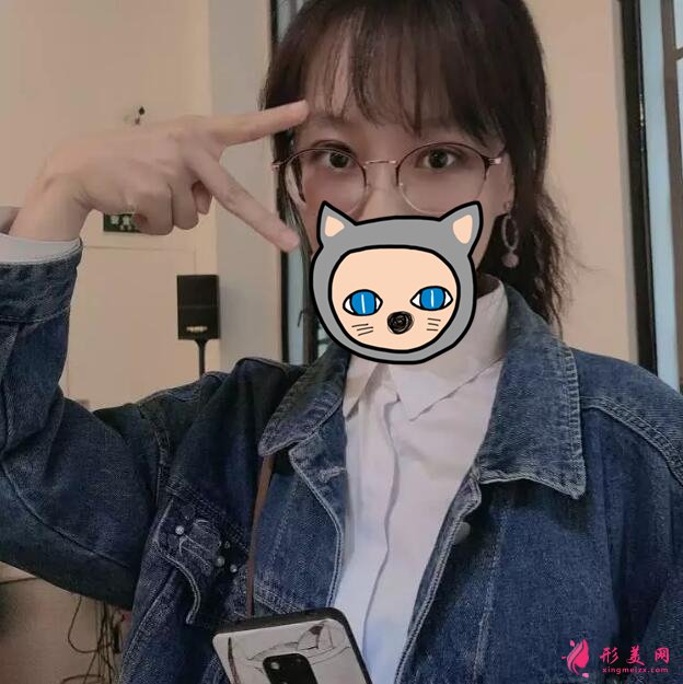 深圳葉琳雙眼皮案例，把小姐姐的美分享給大家