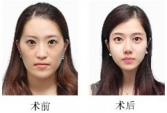 自體脂肪填充臉部怎么樣？需要多少錢(qián)？