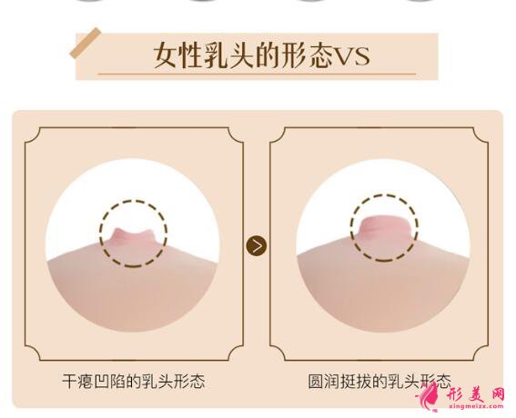 乳頭內(nèi)陷矯正術(shù)后注意事項(xiàng)
