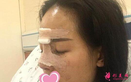 李信鋒做鼻子手術術后第1天