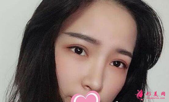 李信鋒做鼻子手術術后第38天