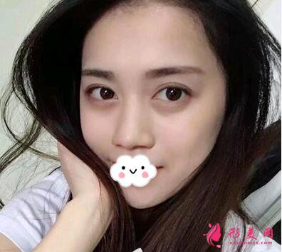 深圳美加美陳群雙眼皮手術術后兩個月