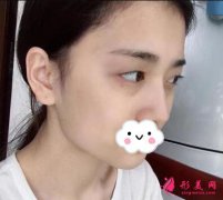 深圳美加美陳群雙眼皮怎么樣？陳群雙眼皮案例看了就知道了
