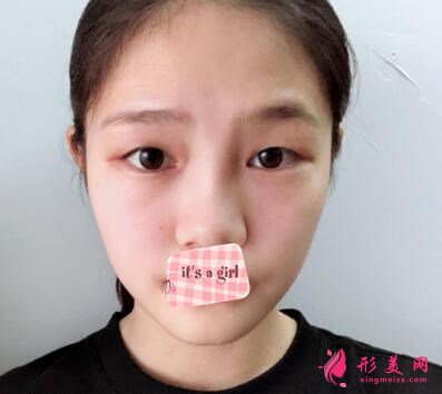 周國偉醫(yī)生做的雙眼皮手術(shù)術(shù)前