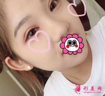 深圳yestar?？溯x雙眼皮手術(shù)術(shù)后一個(gè)月