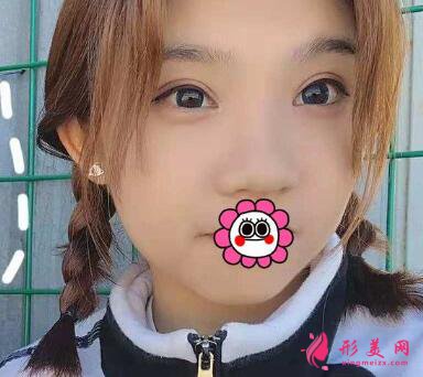 深圳yestar?？溯x雙眼皮手術(shù)術(shù)后半年