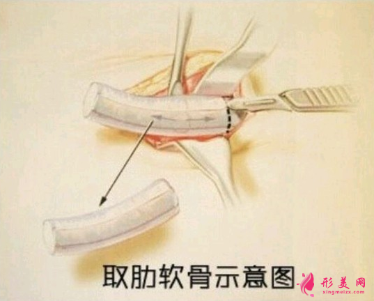 自體肋軟骨隆鼻是在哪取的