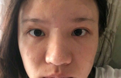 南通附屬醫(yī)院隆鼻多少錢?附隆鼻真人案例分享