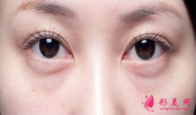 安康永秀吸脂祛眼袋手術(shù)安全嗎