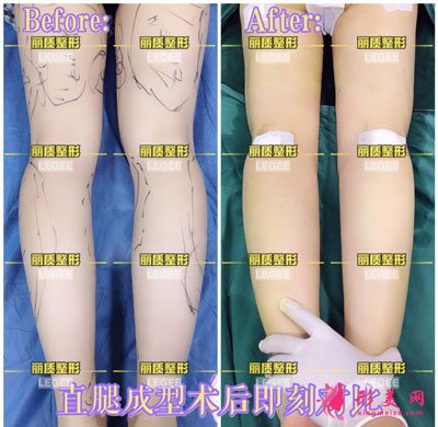 麗質(zhì)直腿瘦小腿術(shù)
