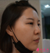 西安葉子整形醫(yī)院隆鼻價(jià)格表和真人真實(shí)案例分享