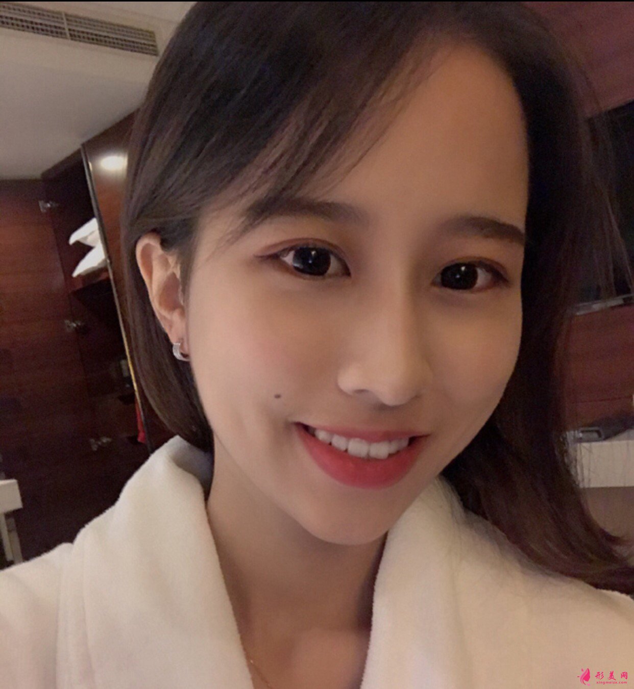 杭州格萊美湯穎峰醫(yī)生雙眼皮修復(fù)+鼻修復(fù)+假體下頦 案例分享