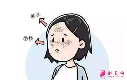 黃褐斑是怎么治療的?