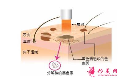 去除黃褐斑前需要注意的事項(xiàng)