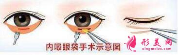 內(nèi)切祛眼袋手術(shù)的禁忌