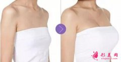 乳房下垂矯正手術(shù)會留疤嘛？