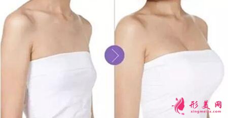 廣西桂林乳房下垂矯正手術(shù)會(huì)留疤么
