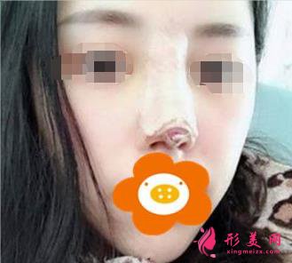 隆鼻三個(gè)月后恢復(fù)效果很好，鼻子形態(tài)自然無(wú)痕