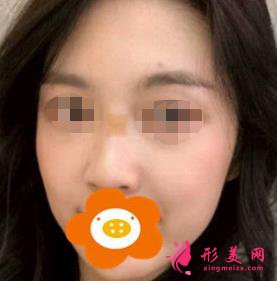 隆鼻三個(gè)月后恢復(fù)效果很好，鼻子形態(tài)自然無(wú)痕