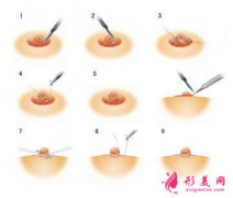 30歲可以做乳頭內(nèi)陷矯正嗎？