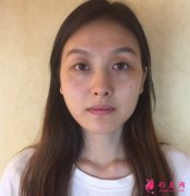 南京韓辰李德慶醫(yī)生隆鼻怎么樣？真人案例 分享