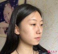 西安美立方李旭平醫(yī)師隆鼻做的怎么樣？真人案例分享
