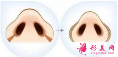 鼻翼縮小手術(shù)多久恢復(fù)自然？