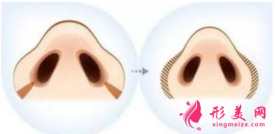 鼻翼縮小手術怎么護理