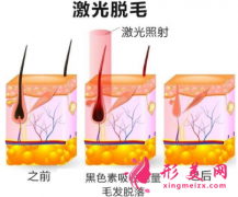 激光脫毛術(shù)前術(shù)后要注意什么？