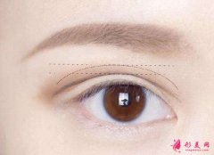 雙眼皮失敗修復(fù)術(shù)有哪些優(yōu)勢(shì)？