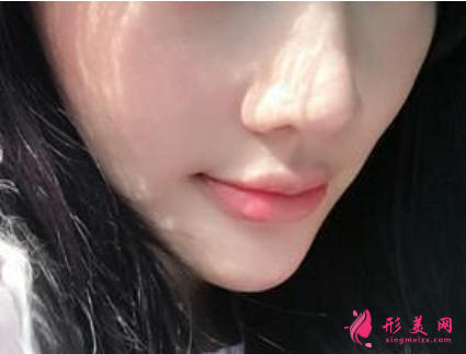 打完瘦臉針幾天有效果