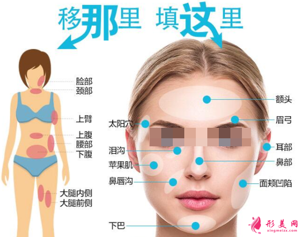 自體脂肪填充臉部有硬塊怎么辦